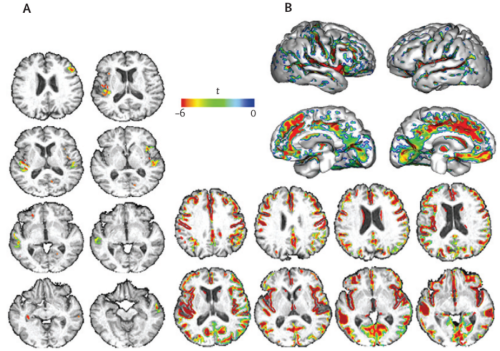Image showing cerebral regions in which decreasing grey-matter volumes were significantly associated with increasing systolic blood pressure (A) and age (B)