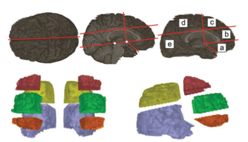 Figure: The definition of 10 volumes of interest from the high-resolution three-dimensional T1-weighted MR image. Anatomic landmarks used are anterior and posterior commissures (white dots), outer boundary of callosal body, and the point where the frontal and temporal lobes meet; a = orbitofrontal; b = prefrontal; c = dorsolateral frontal; d = parietal; e = occipitotemporal