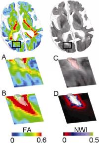 Illustrations of FA in regions exhibiting high and low neighbourhood white matter injury (NWI) scores, along with a visual depiction of the NWI score calculation. Top row: Oblique 3D view of one elderly subject's fractional anisotropy (FA) (left) and FLAIR (right) maps, coregistered to the same space.