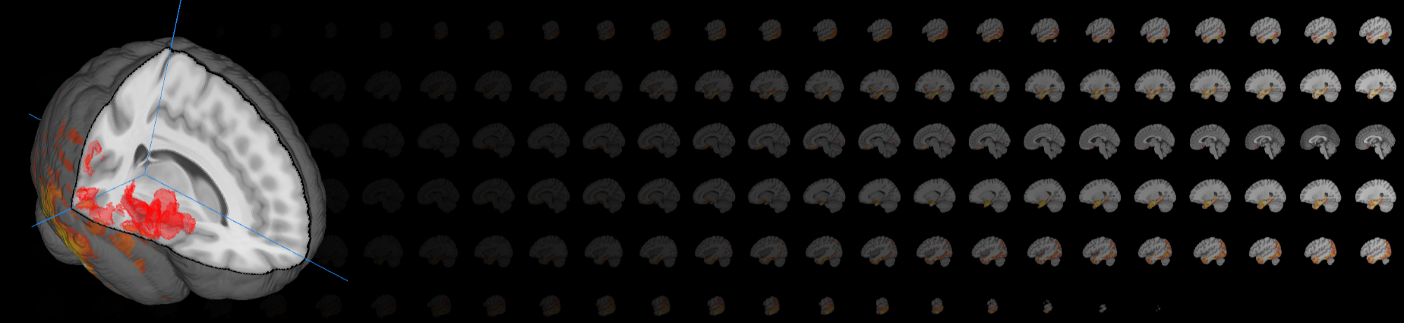 Cutaway MRI brain with brain slices in the background